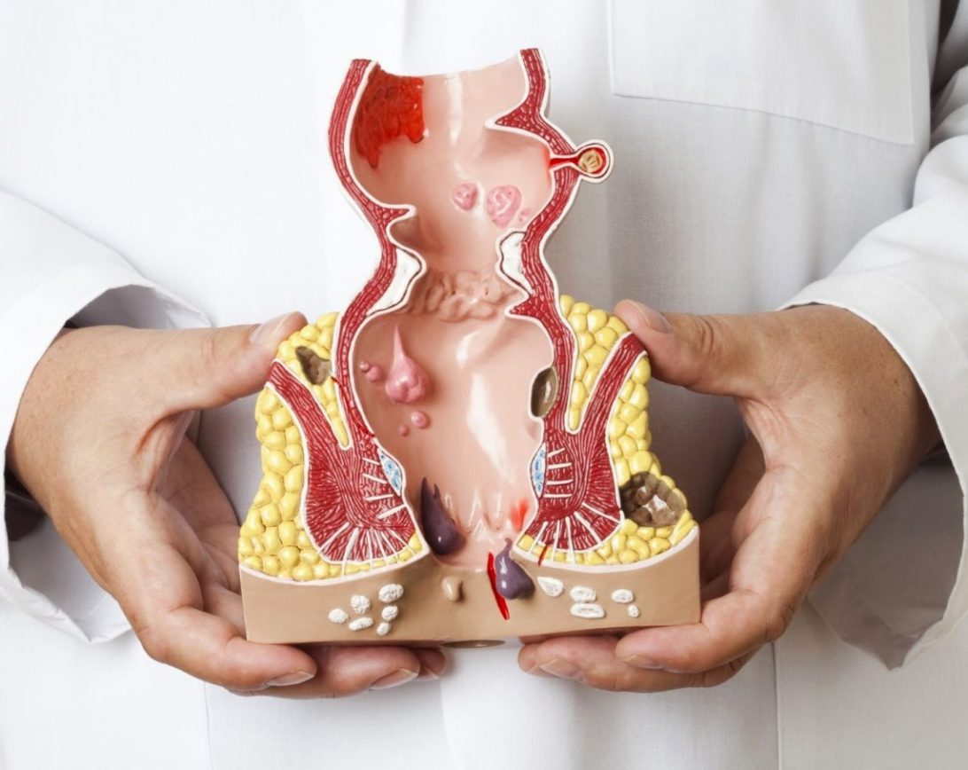 severe haemorrhoids 6