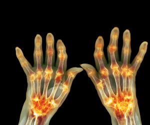 petua hilangkan sakit arthritis
